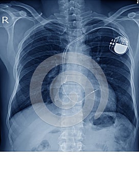 X-ray image of permanent pacemaker implant in chest body , process in blue tone