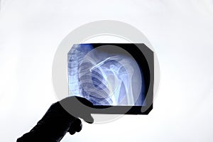 X ray image person with broken collarbone and spoke installed in it after surgery