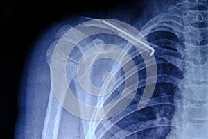 X ray image person with broken collarbone and spoke installed in it after surgery