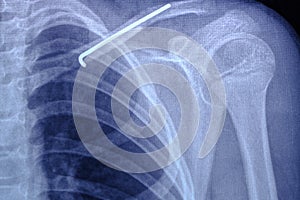 X ray image person with broken collarbone and spoke installed in it after surgery