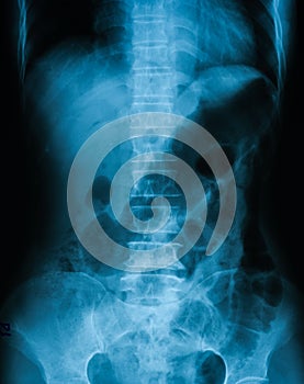 X-ray image of plain abdomen.