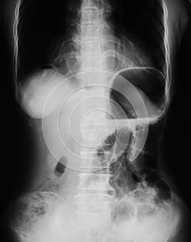 X-ray image of plain abdomen.