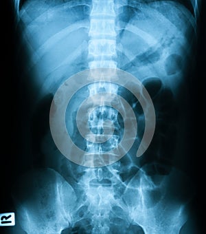 X-ray image of plain abdomen.