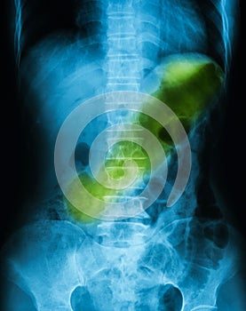 X-ray image of plain abdomen supine.