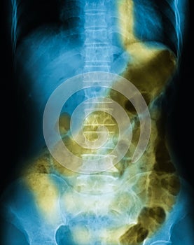 X-ray image of plain abdomen supine.