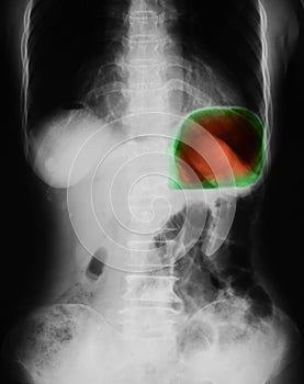 X-ray image of plain abdomen upright.