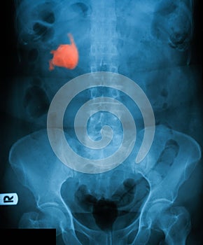 X-ray image of plain KUB.