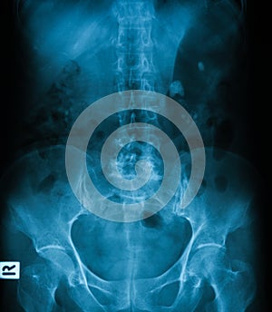 X-ray image of plain KUB.