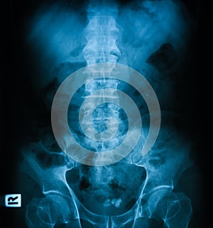 X-ray image of plain KUB.