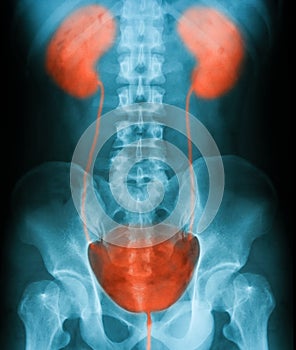 X-ray image of plain KUB.