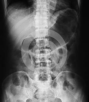 X-ray image of plan abdomen.