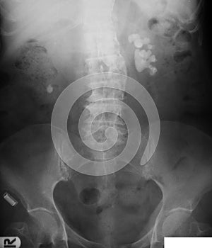 X-ray image of plan KUB(Kidney,Ureter and Bladder), supine view