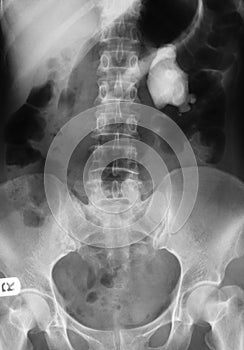 X-ray image of Plan KUB, supine view.