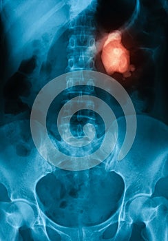 X-ray image of Plan KUB, supine view.