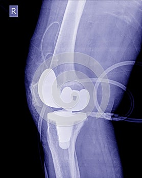 X-ray image post operation total knee replacement