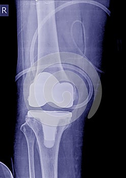 X-ray image post operation total knee replacement