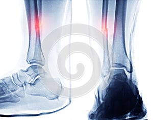 X-ray image of right ankle joint.