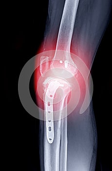 X-ray image of  Right knee lateral view