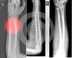 X-ray image right of wrist joint, shows fracture of the distal radius and ulna photo