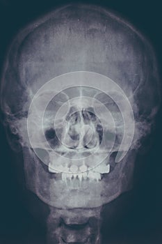 X-ray image or roentgen of human skull, close-up. Head xray scan of skeleton head. Abstract medical concept