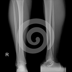 X-ray image of shin , Frontal Sagital view normal. photo