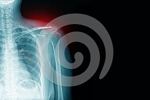 x-ray image of shoulder pain with clavicle fracture with post-op and screw medical healthcare concept.