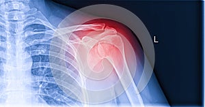 X-ray image of shoulder pain, shoulder ligament tendinitis, shoulder muscle strain