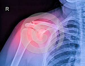 X-ray image of shoulder pain, shoulder ligament tendinitis, shoulder muscle strain