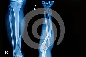 X-ray image show fracture leg and forearm