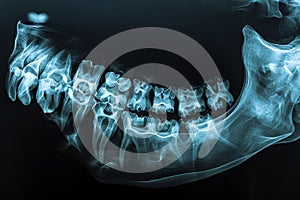 An x-ray image showing a dental arch with multiple teeth missing, High resolution X-ray film of the jawbone, AI Generated