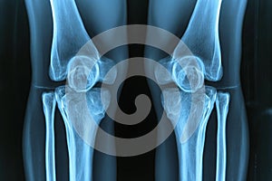 This x-ray image shows a detailed view of a knee joint, providing insights into its structure and potential abnormalities, High