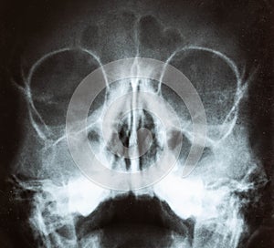 X-ray image of the skull of a child with purulent sinusitis, close-up. Treatment of inflamed sinuses, purulent secretion