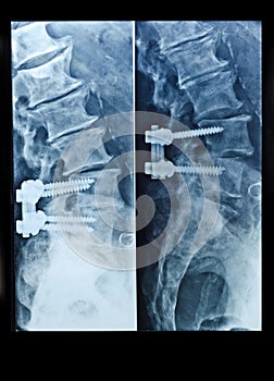 X-Ray image of spinal column with screws after surgery