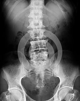 X-ray image of spine, AP view.