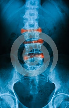 X-ray image of spine, AP view.