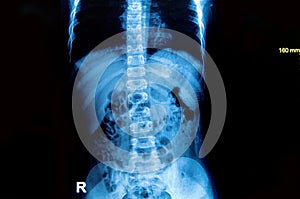 X-ray image spine and pelvis