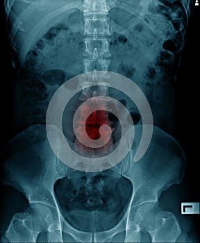 X-ray image of spine show degeneration of lumbar