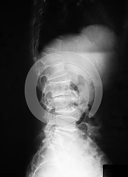 X-ray image of T-L spine, lateral view.