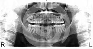 X-ray image of teeth