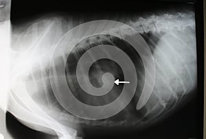 X-ray image of thorax with tumor