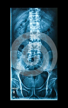 X-Ray image, View of backbone men for medical diagnosis.