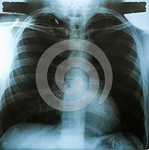 X-Ray image, View of chest men for medical diagnosis.