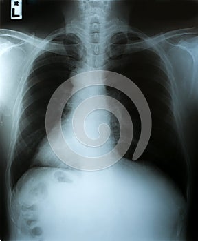 X-Ray image, View of chest men for medical diagnosis.