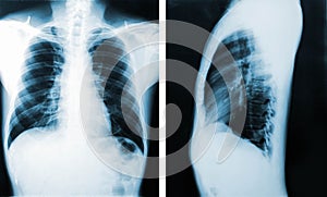 X-Ray image, View of chest men for medical diagnosis.