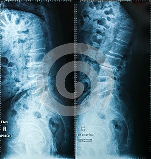 X-Ray image, View of neck men for medical diagnosis.