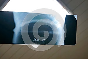 X-ray image of a welded joint of a process pipeline at an oil and chemical plant