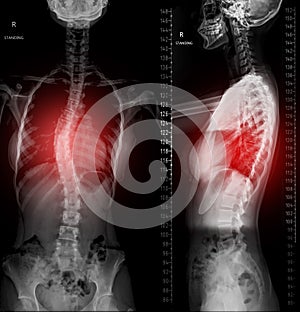 X-ray image of Whole Spine Scanography . AP and Lateral view .