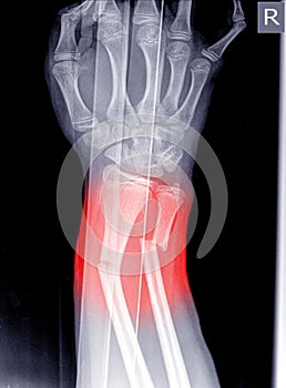 X-ray image of wrist joint, shows fracture of the distal radius and ulna on color mark photo