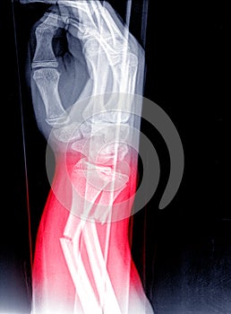 X-ray image of wrist joint, shows fracture of the distal radius and ulna on color mark photo