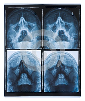 X-ray images of human skull isolated on white background